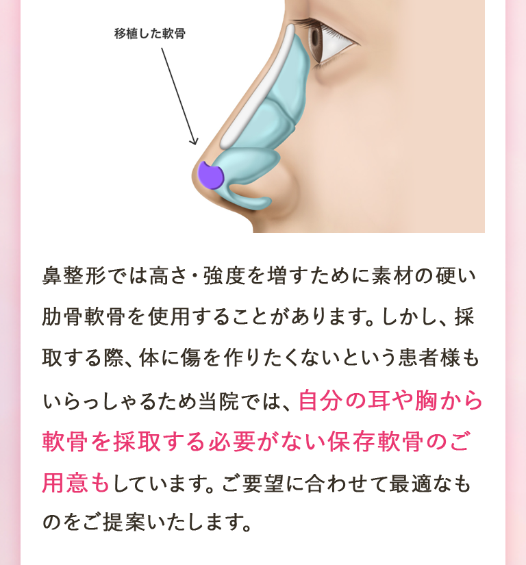 鼻整形では高さ・強度を増すために素材の硬い肋骨軟骨を使用することがあります。しかし、採取する際、体に傷を作りたくないという患者様もいらっしゃるため当院では、自分の耳や胸から軟骨を採取する必要がない保存軟骨のご用意もしています。ご要望に合わせて最適なものをご提案いたします。