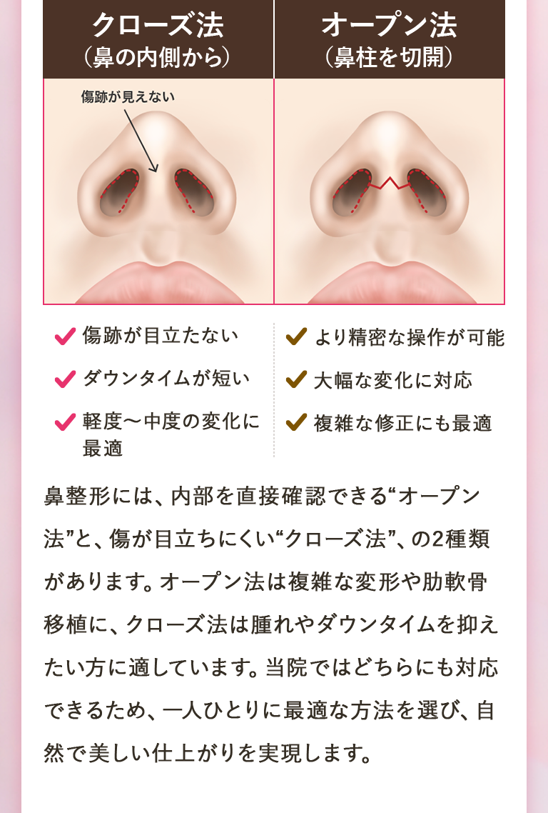 【クローズ法（鼻の内側から）】傷跡が目立たない/ダウンタイムが短い/軽度〜中度の変化に最適｜【オープン法（鼻柱を切開）】より精密な操作が可能/大幅な変化に対応/複雑な修正にも最適｜鼻整形には、内部を直接確認できる「オープン法」と、傷が目立ちにくい「クローズ法」、の2種類があります。オープン法は複雑な変形や肋軟骨移植に、クローズ法は腫れやダウンタイムを抑えたい方に適しています。当院ではどちらにも対応できるため、一人ひとりに最適な方法を選び、自然で美しい仕上がりを実現します。