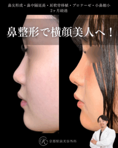 鼻尖形成、耳軟骨移植、耳介軟骨による鼻中隔延長、小鼻縮小、プロテーゼなど（京都駅前美容外科の症例）