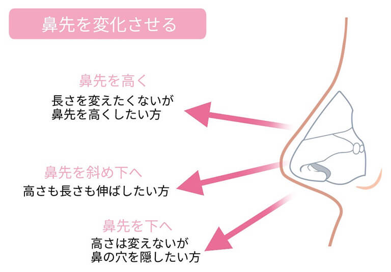 鼻中隔延長とは