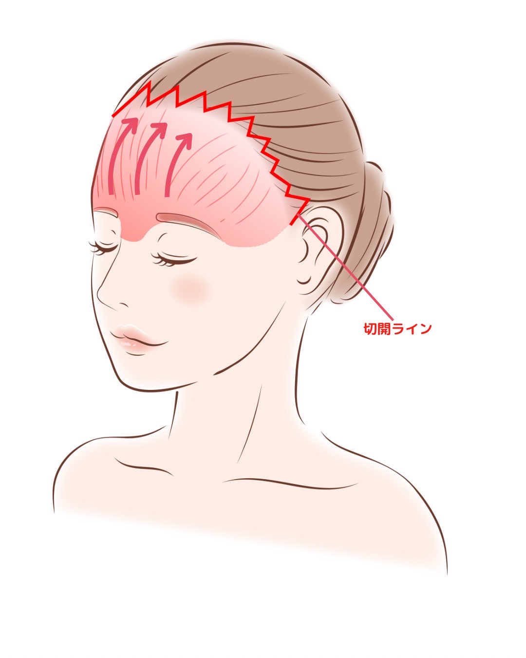 前頭筋不動とは