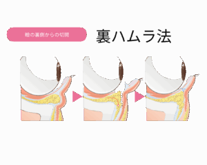 京都駅前美容外科の裏ハムラ法のイラストです。