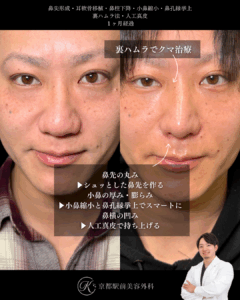 鼻尖形成・耳軟骨移植・小鼻縮小・鼻孔縁挙上・人工真皮・裏ハムラ法の術後経過写真（京都駅前美容外科の症例写真）