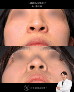 小鼻縮小内外側法の術後３ヶ月症例画像（京都駅前美容外科の症例）