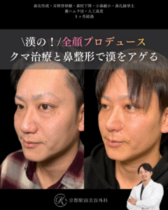 鼻尖形成・耳軟骨移植・小鼻縮小・鼻孔縁挙上・人工真皮・裏ハムラ法の術後経過写真（京都駅前美容外科の症例写真）