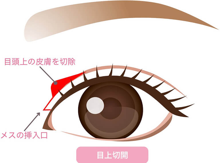 目の上切開とは
