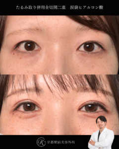 たるみ取り併用全切開二重と涙袋ヒアルロン酸の症例（京都駅前美容外科の症例）