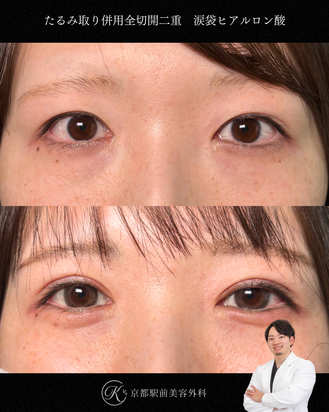 たるみ取り併用全切開二重と涙袋ヒアルロン酸の症例（京都駅前美容外科の症例）