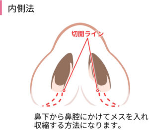 内側法（引き締め縫合）
