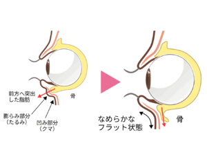クマ取り(脱脂と目の下、ゴルゴ脂肪注入)をした時の横顔の断面図です。(京都駅前美容外科のイラスト)