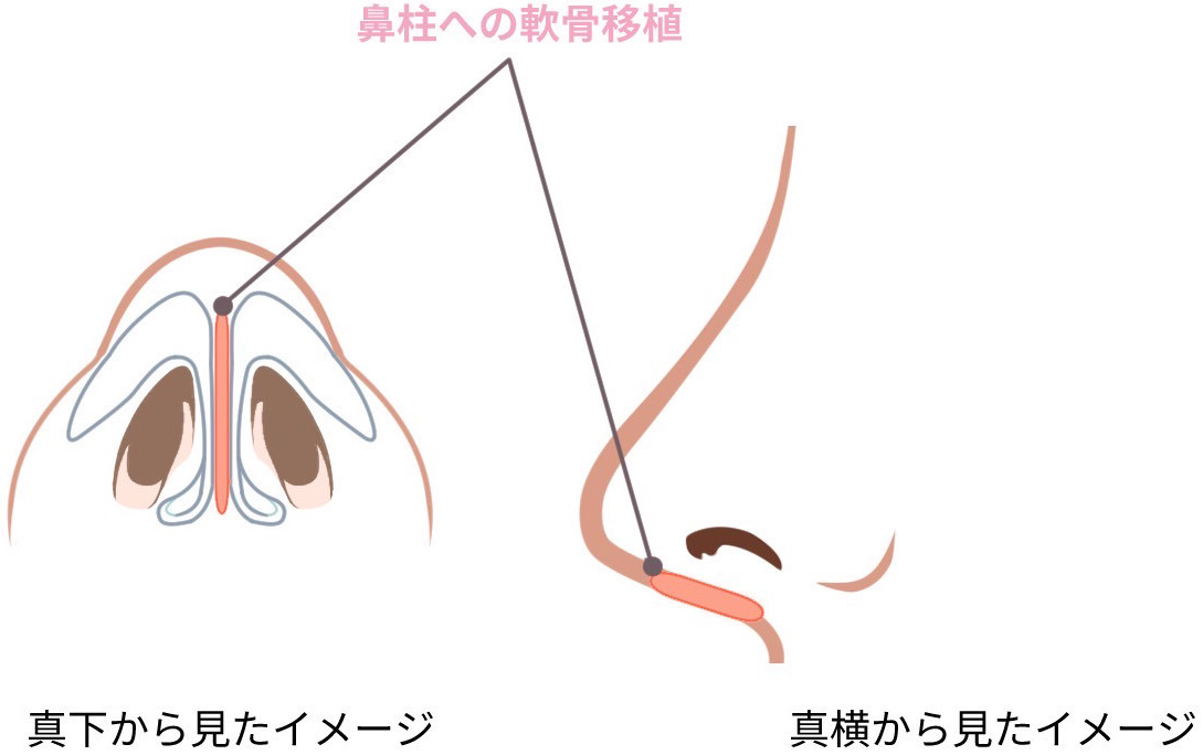 鼻柱下降術の施術方法