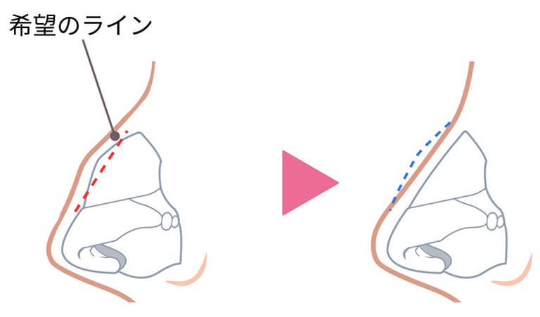 わし鼻の修正