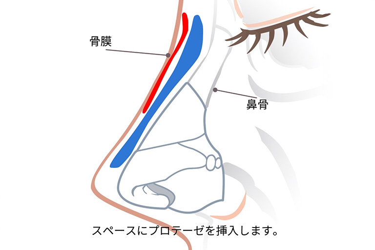 プロテーゼ