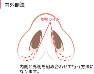内外側法（引き締め縫合）