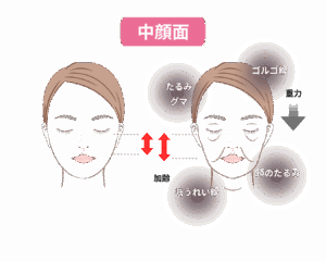 老化による中顔面の老化現象を表した京都駅前美容外科のイラストです。