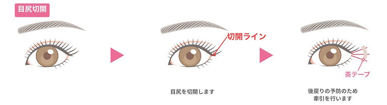 目尻切開の手術方法