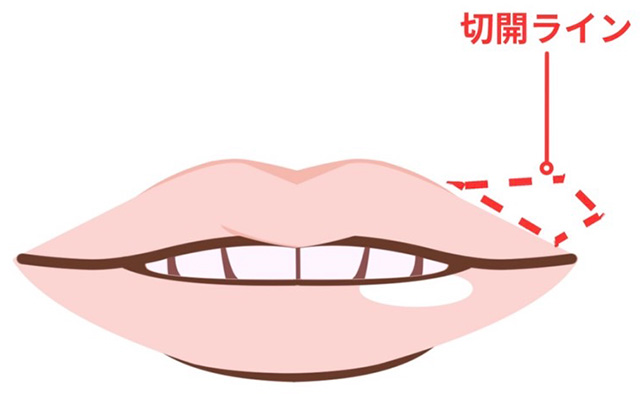 外側法