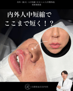 内外側人中短縮の症例写真（京都駅前美容外科の症例）