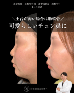 鼻尖形成、耳軟骨移植、肋軟骨による鼻中隔延長など（京都駅前美容外科の症例）