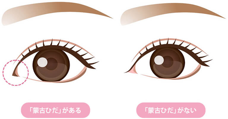 目頭切開とは