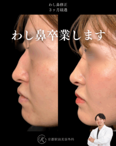 わし鼻修正の3ヶ月経過写真（京都駅前美容外科の鼻整形症例）