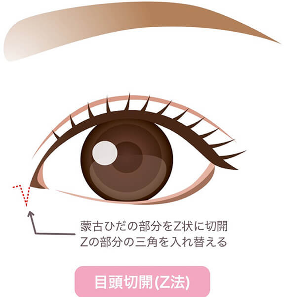 目頭切開とは