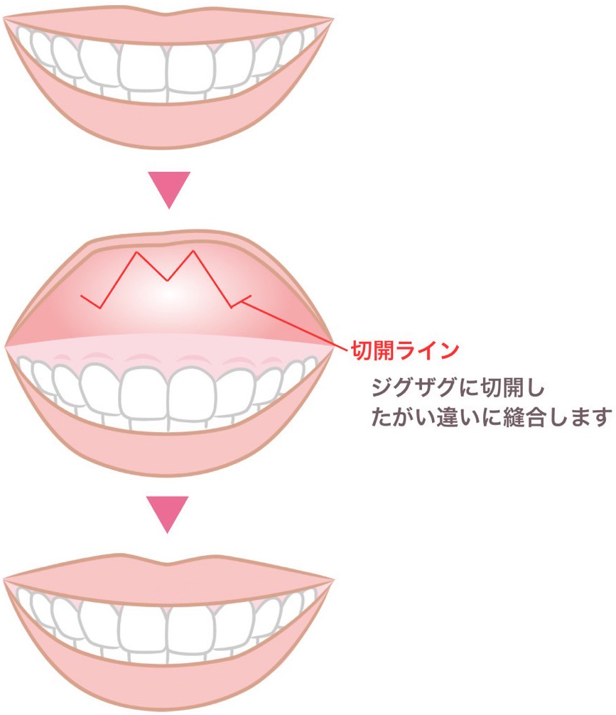 口唇拡大術とは？