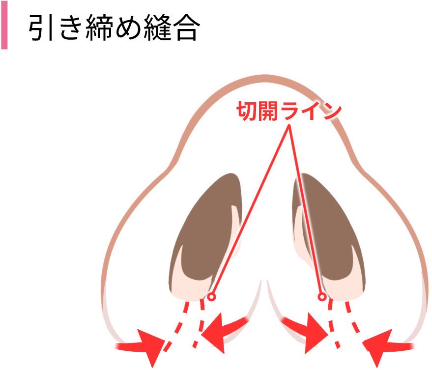 小鼻縮小の手術方法