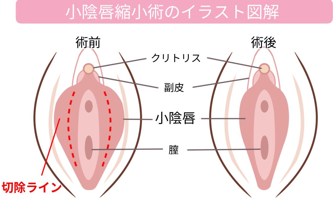 小陰唇縮小術のイラスト図解