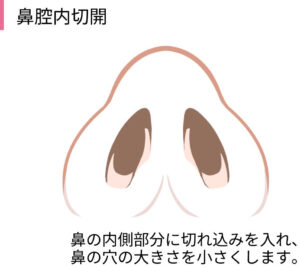 鼻腔内切開（引き締め縫合）