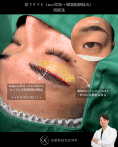 眉下切開、roof除去、眼窩脂肪除去の症例。京都駅前美容外科の症例写真。