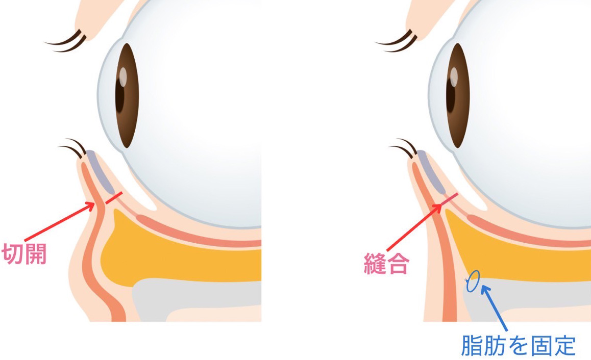 表ハムラ法の手術方法