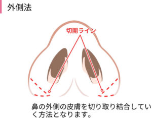 外側法（引き締め縫合）