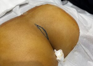 真皮脂肪移植の採取前