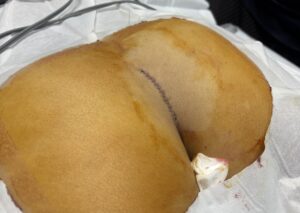 真皮脂肪移植の採取後