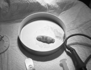 採取した真皮脂肪組織