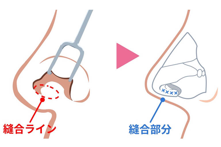 鼻柱挙上術