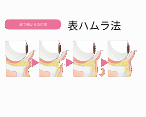 表ハムラ法のイラスト(京都駅前美容外科のイラスト)