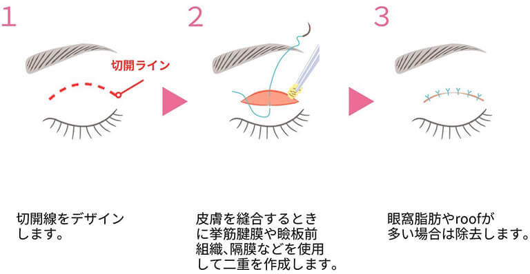 二重全切開とは