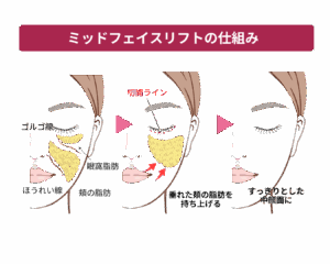京都駅前美容外科のミッドフェイスリフトの仕組みを解説したイラストです。ミッドフェイスリフト(チークリフトアップ)により若々しい印象を与えることができます。