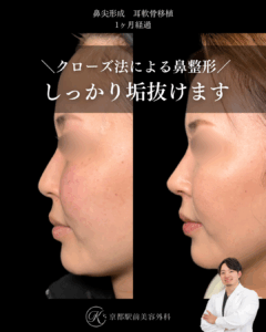 クローズ法の鼻先整形。鼻尖形成・耳軟骨移植の１ヶ月経過写真（京都駅前美容外科の鼻整形症例）