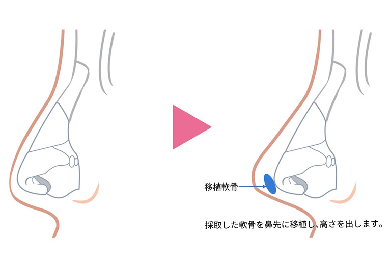 耳軟骨移植