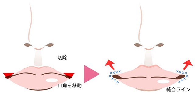 皮弁法