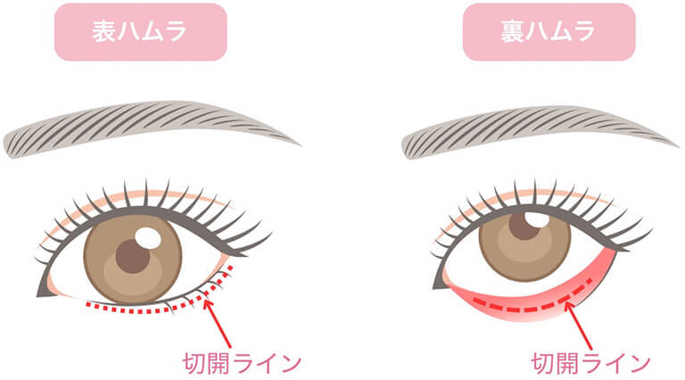 裏ハムラ法とは