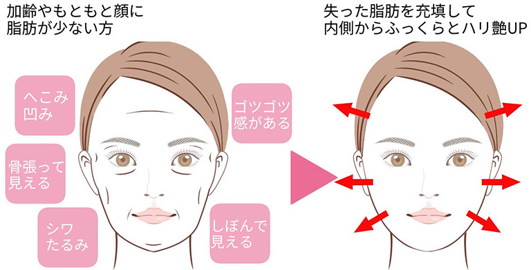 脂肪注入とは