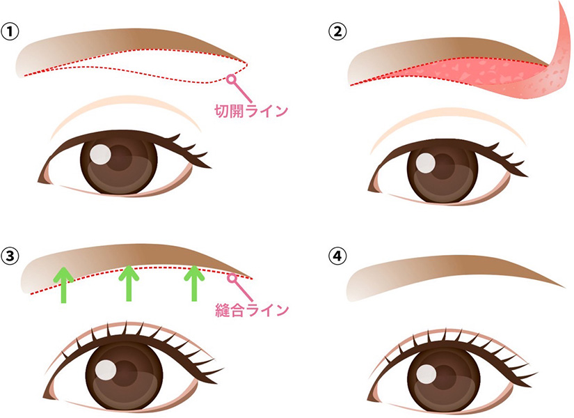 眉下切開（眼輪筋内部処理込み）とは