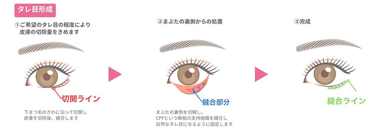 タレ目形成の手術方法