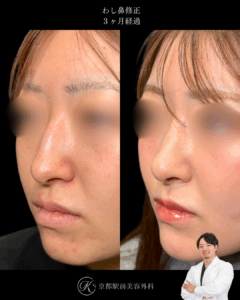 わし鼻修正の3ヶ月経過写真（京都駅前美容外科の鼻整形症例）