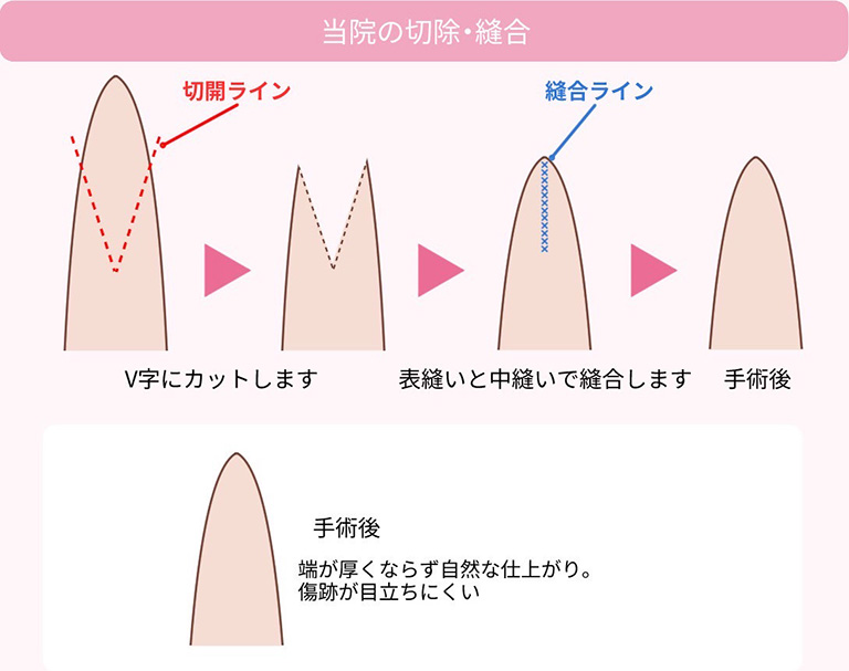 京都駅前美容外科の手術のこだわり