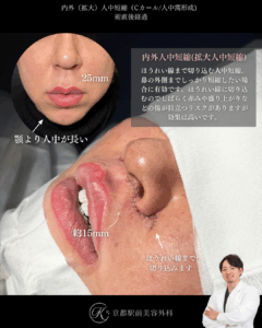 内外側人中短縮の症例写真（京都駅前美容外科の症例）